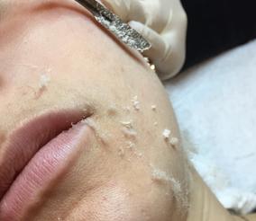 Dermaplaning